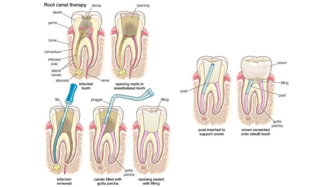 Procedure for root canal