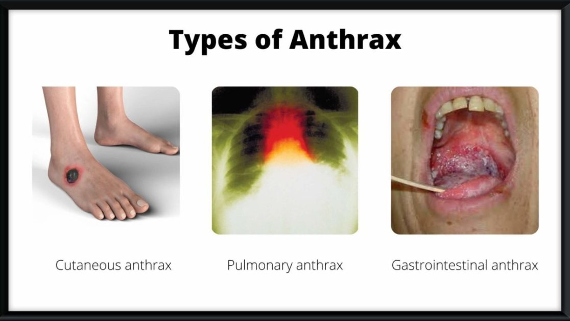 What Are The Major Types Of Anthrax