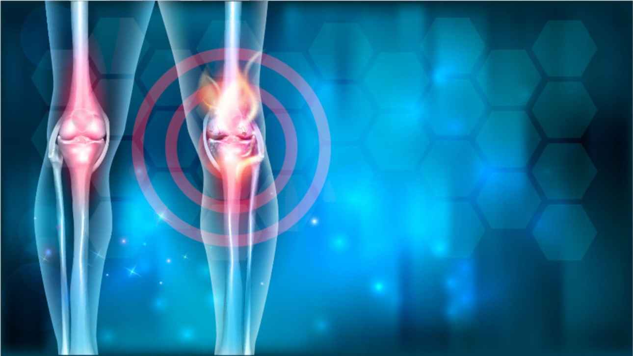 Arthrosis or Osteoarthritis