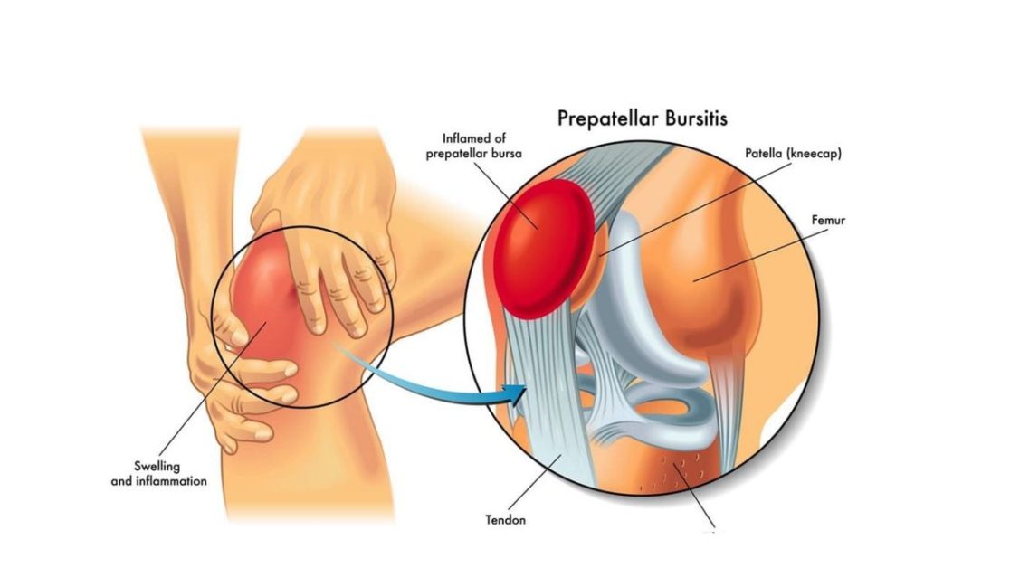 Bursitis (It is an inflammation or irritation of a bursa)