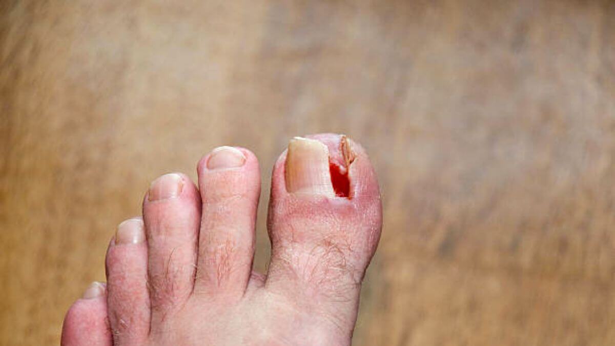 How To Manage Toenail Falling Off