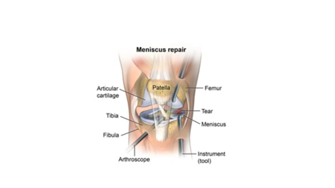 Meniscus