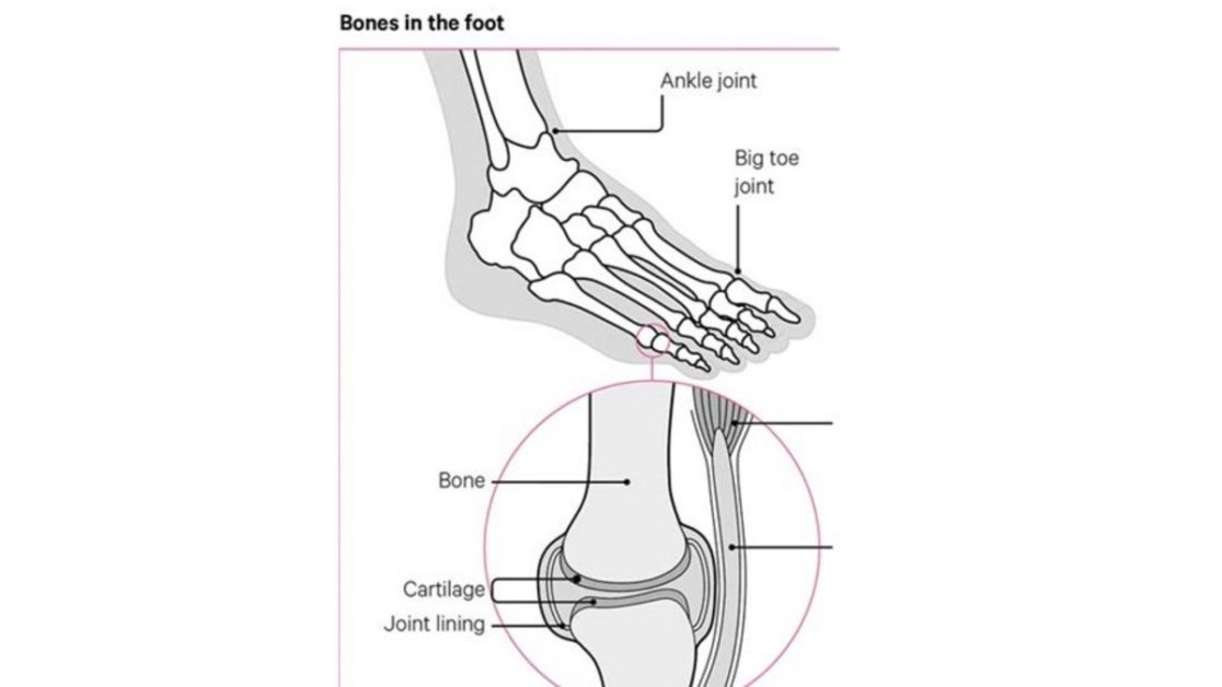 Osteoarthritis (OA)