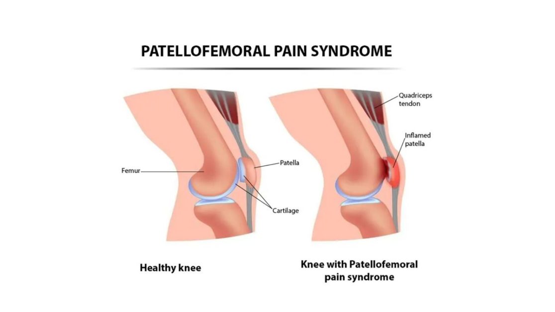 Patellofemoral Pain Syndrome