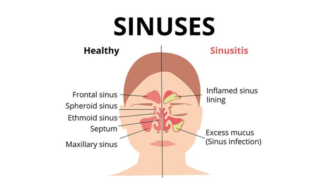 Relieve Jaw Pain From Sinus Infection