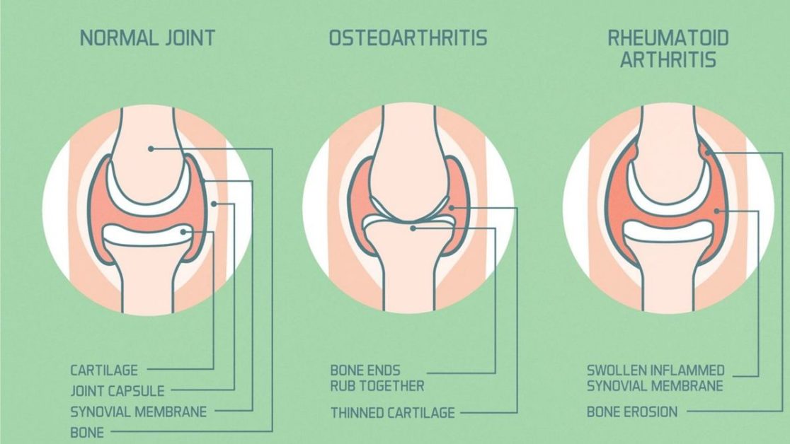 Rheumatoid Arthritis (RA)