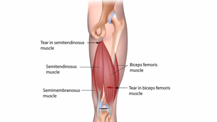 Semitendinosus Pain Treatments