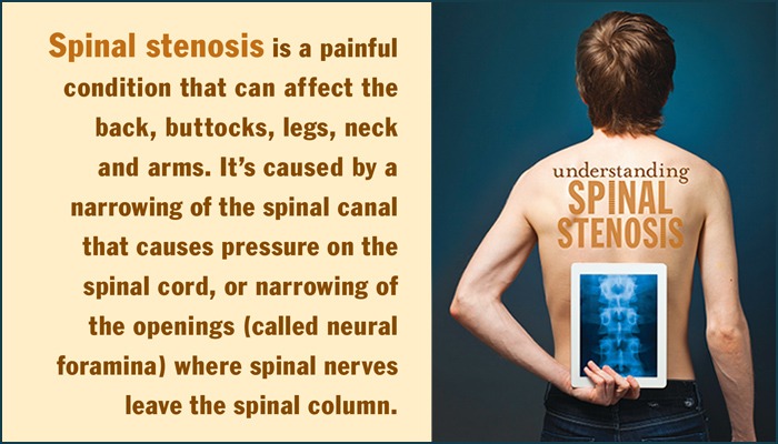 Spinal Stenosis