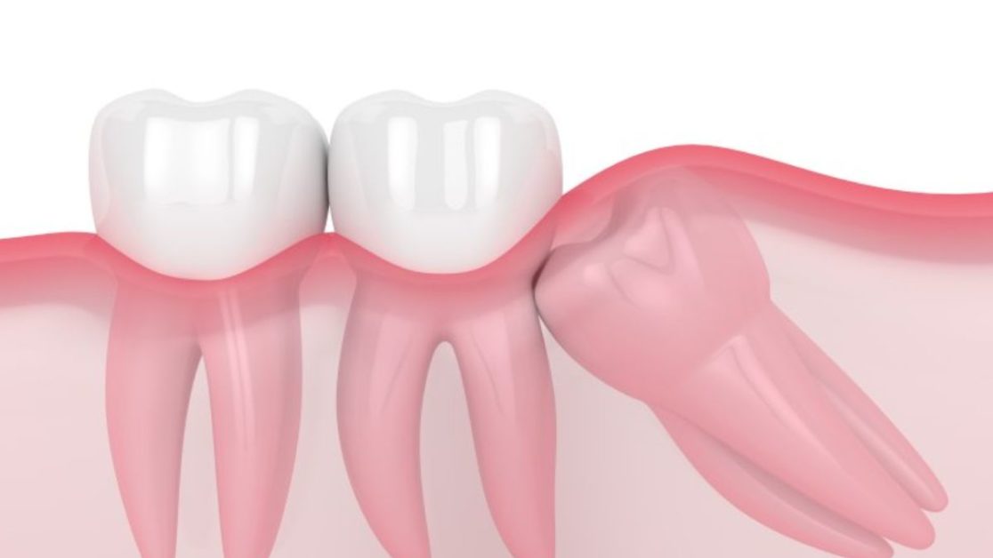 symptoms of wisdom teeth