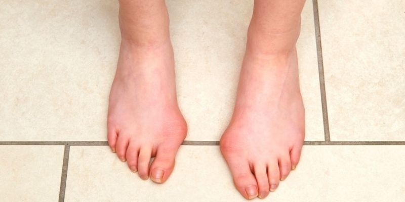 What Causes Bunions The Painful Condition