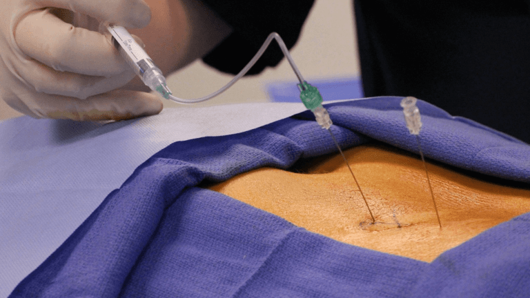 Epidural Injection For Back Pain – Benefits And Side Effects!