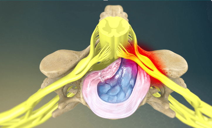 Herniated disc