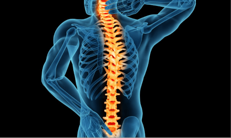 VCF or Vertebral Compression Fracture