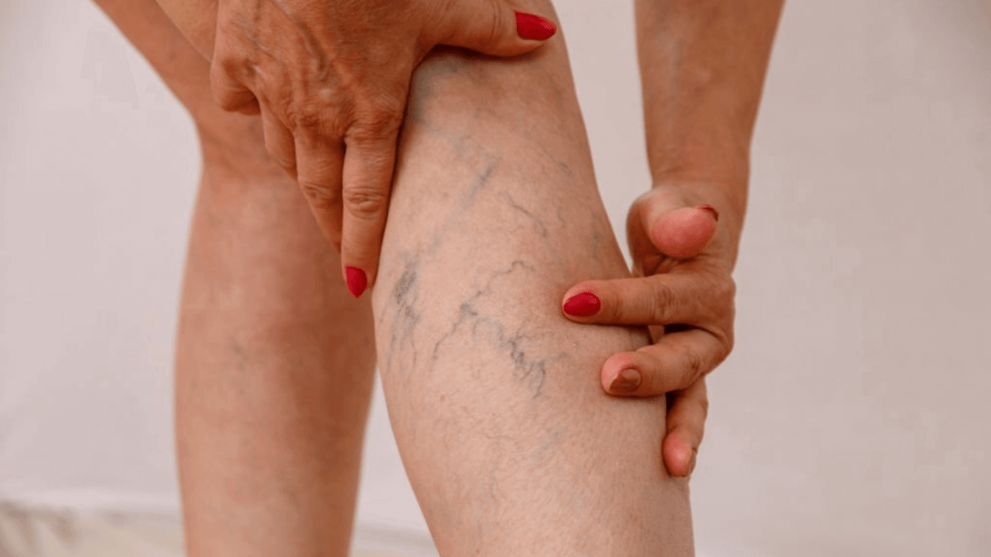 What Are Varicose Veins